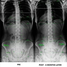 Chiropractic Weldon Spring MO SM Before & After