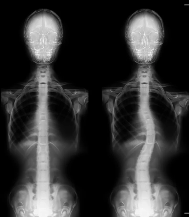 Scoliosis Weldon Spring