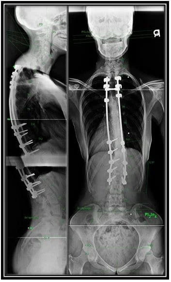 Testimonial Full body xray results
