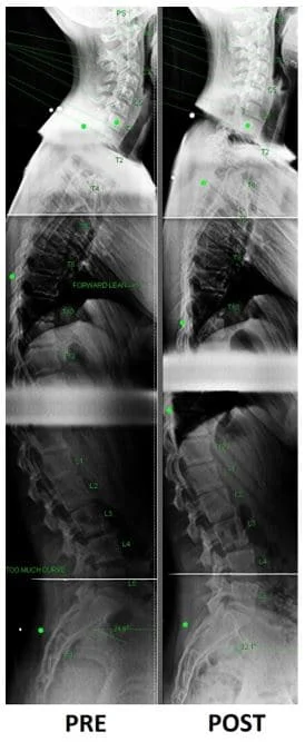 Testimonial pre and post xray improvement