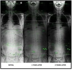 Testimonial 2 year improvement xrays